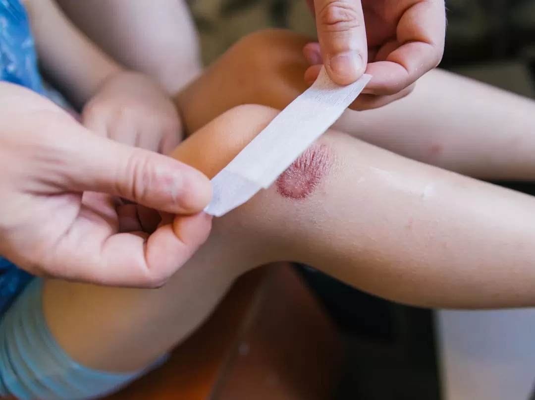 Tratamento de feridas