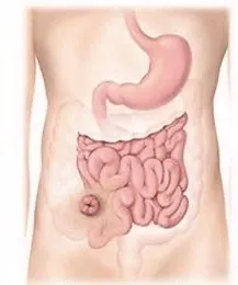 Ileostomia